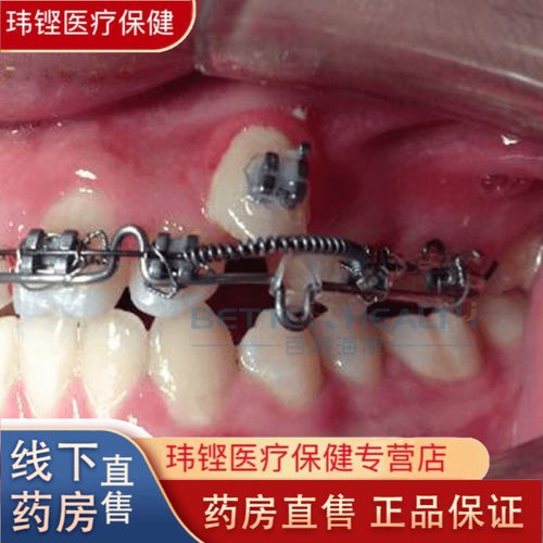 矫正牙齿要带多久弹簧-图2