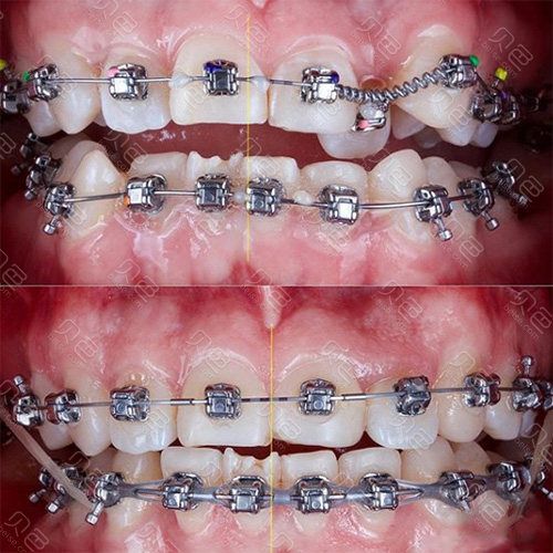 矫正牙齿要带多久弹簧-图3