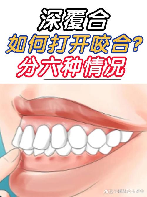 矫正牙齿如何精准调整咬合？-图2