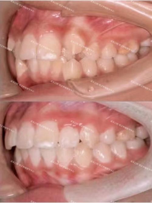 拥挤牙齿矫正失败案例频发，究竟哪些环节导致矫正失败？-图1