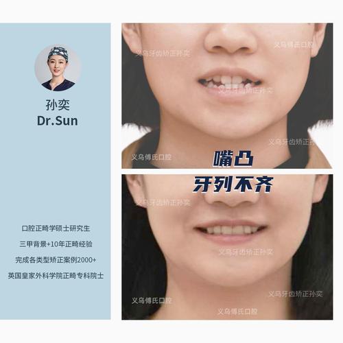 拥挤牙齿矫正失败案例频发，究竟哪些环节导致矫正失败？-图3