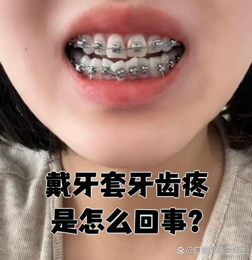 牙齿矫正后为何会痛？是正常现象吗？-图3