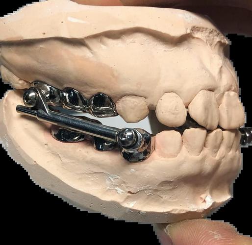 矫正牙齿有哪些矫正器类型？-图2