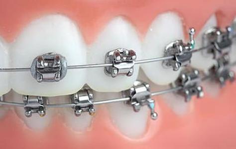 矫正牙齿的矫正器掉了-图1