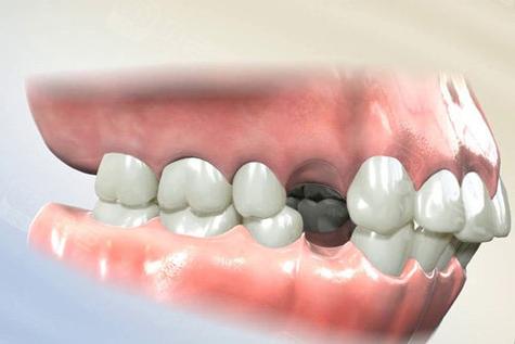 拔牙矫正会导致牙齿松动吗？-图1