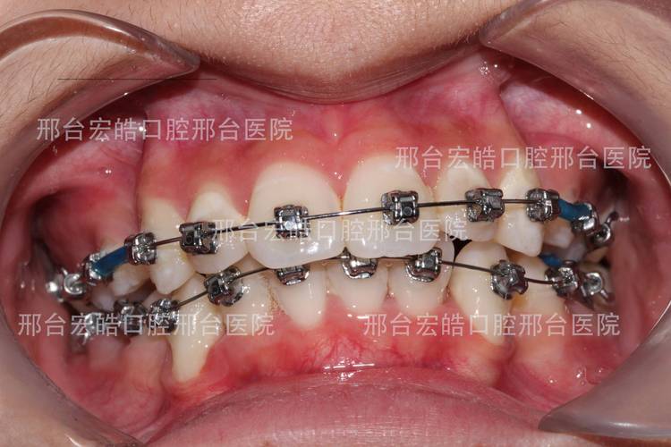 矫正 咬合 磨损牙齿-图1