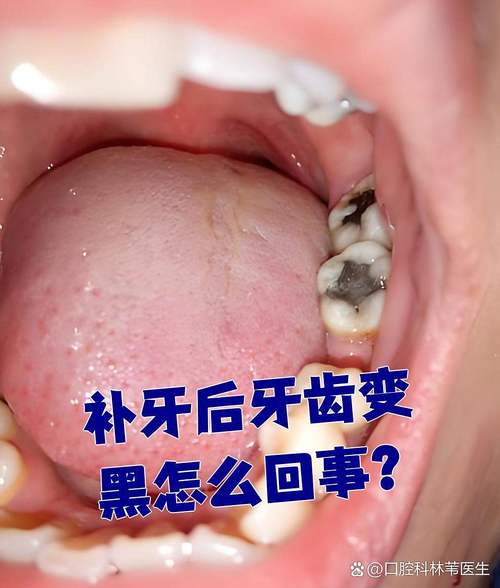 矫正牙齿会让牙齿变黑吗？-图2