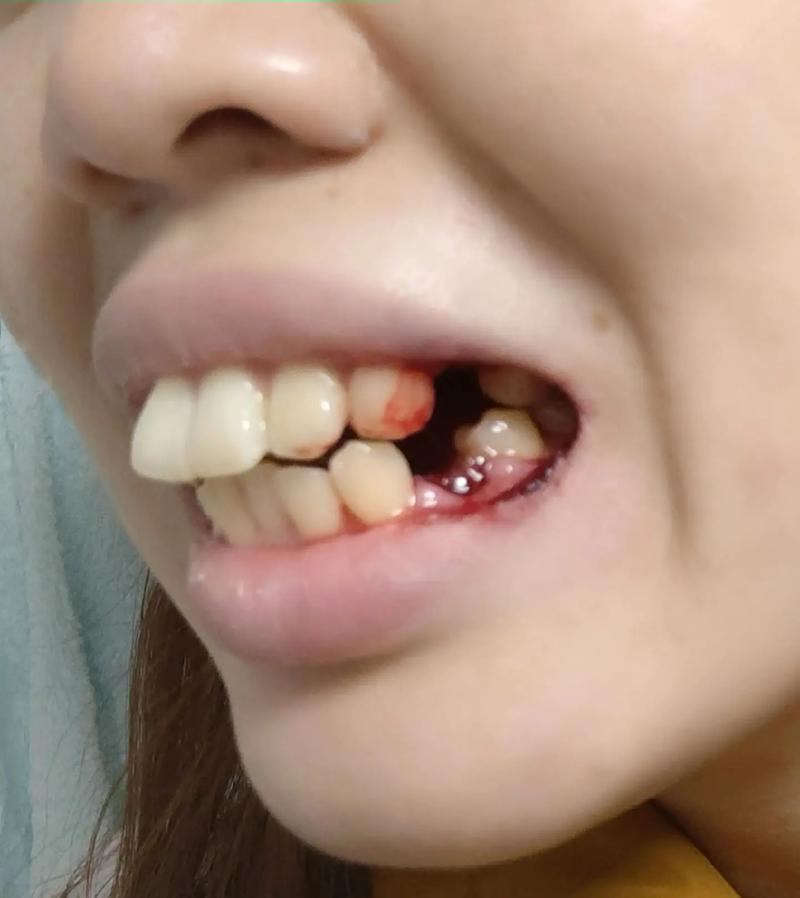 牙齿矫正后牙齿松动，是矫正过程中的正常反应吗？-图2