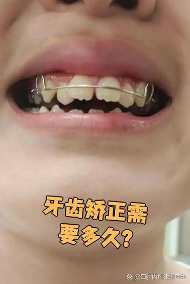 二十二岁矫正牙齿还来得及吗?-图1 二十二岁矫正牙齿还来得及吗?-图1