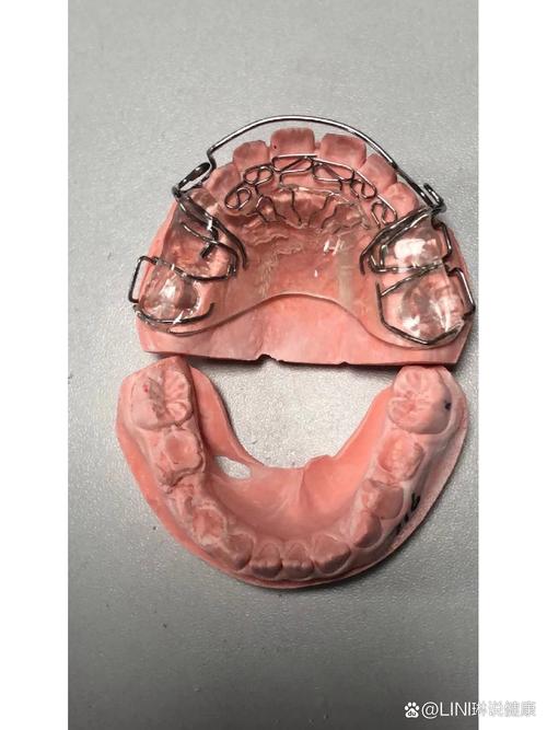 牙齿矫正器什么牌的好？热门品牌优缺点对比及选购建议-图3