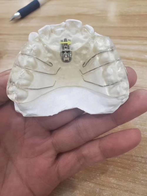 牙齿矫正器什么牌的好？热门品牌优缺点对比及选购建议-图2