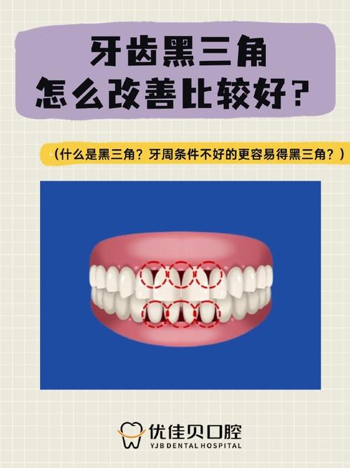 牙齿矫正后黑三角会自行变好吗？-图2