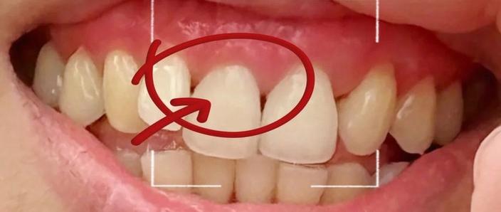 牙齿矫正后黑三角会自行变好吗？-图3