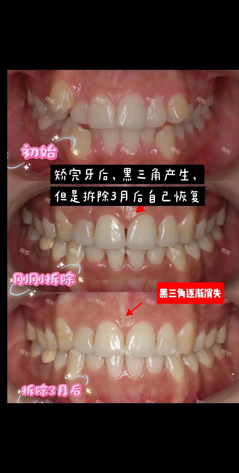 牙齿矫正后出现黑三角-图1