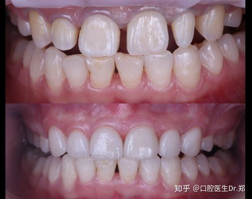 矫正牙齿后为何有黑三角？原因和解决方法-图2