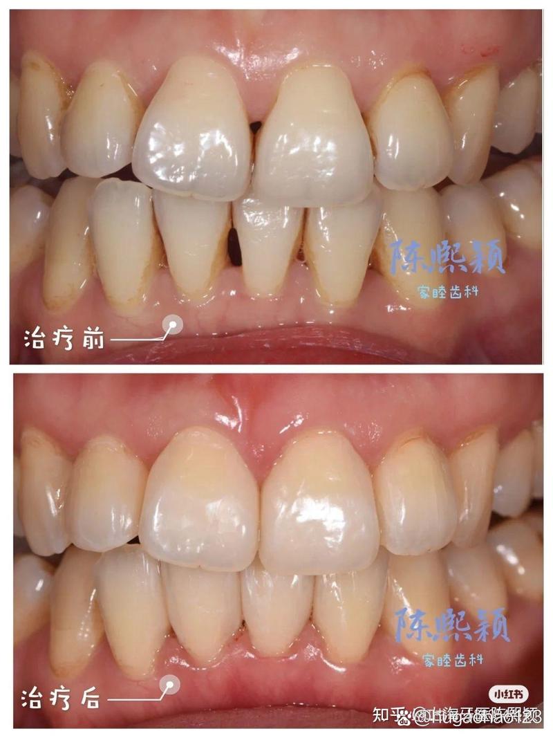 矫正牙齿黑三角是什么？-图1