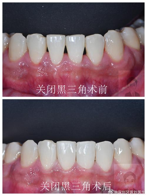 矫正牙齿黑三角是什么？-图3