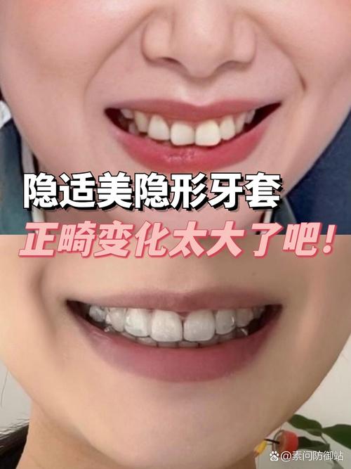 矫正中途换隐适美可行?效果会受影响吗?-图3 矫正中途换隐适美可行?效果会受影响吗?-图3
