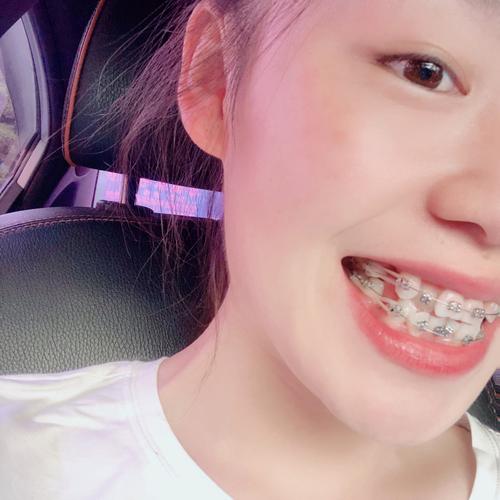 矫正牙齿后期为何要拉橡皮筋？作用、方法及时长解析？-图1