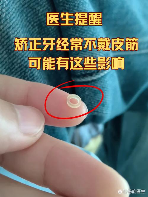 矫正牙齿后期为何要拉橡皮筋？作用、方法及时长解析？-图2