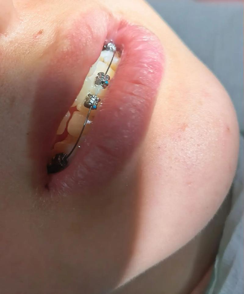 矫正牙齿钢丝总戳嘴，到底该怎么处理？-图2