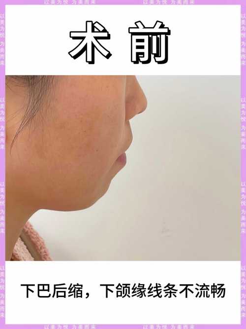牙齿矫正会让下巴变长吗？-图3
