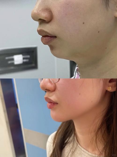 牙齿矫正会让下巴变长吗？-图2