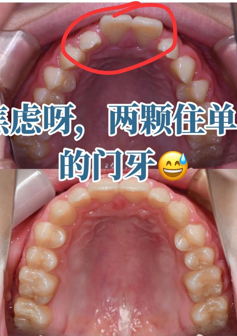 牙齿矫正能改变嘴型吗-图1