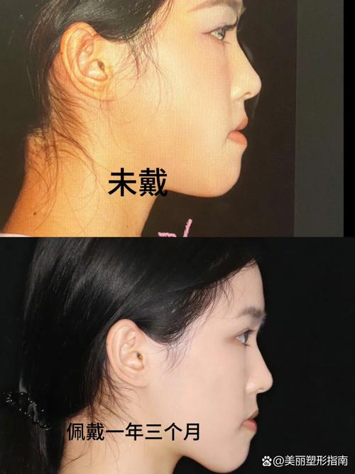 牙齿矫正能改变嘴型吗-图2