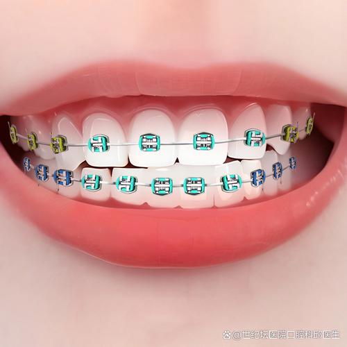 矫正牙齿用什么牙套好？不同牙套怎么选更合适？-图1