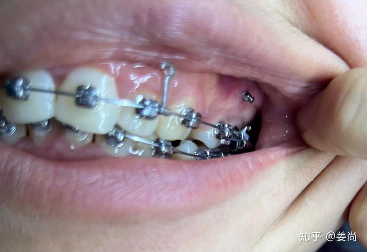 hg一天口腔一天牙齿矫正真的靠谱吗？-图3