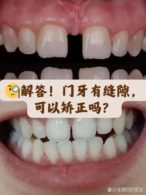 门牙可以只矫正不碰其他牙吗？-图3