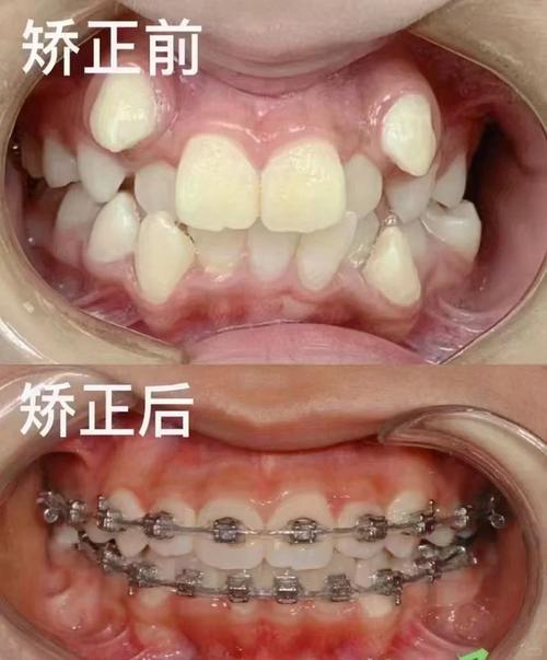 汉中市牙齿矫正哪家好-图1