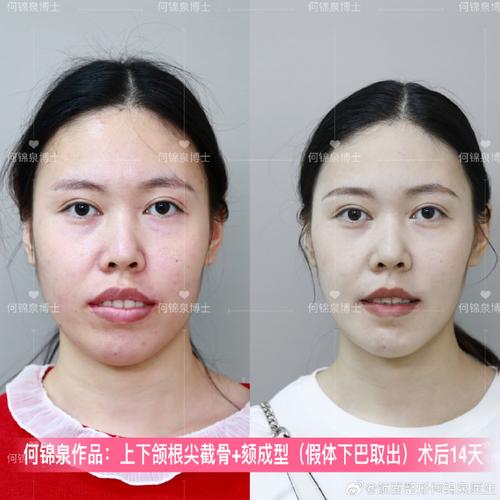 27岁矫正牙齿好不好？会不会太晚？效果会打折扣吗？-图1