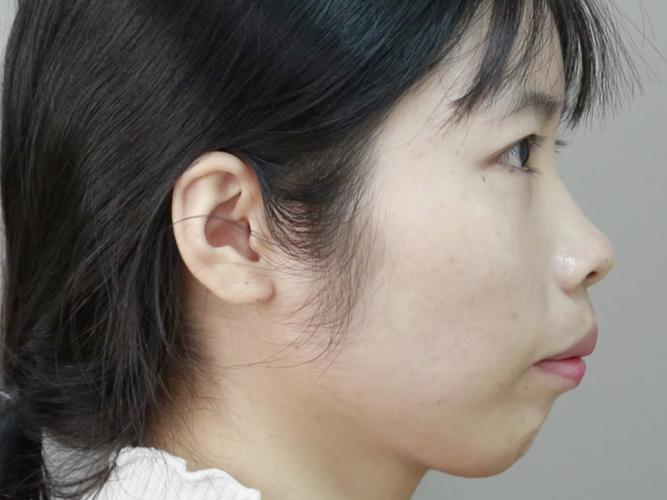 27岁矫正牙齿好不好？会不会太晚？效果会打折扣吗？-图2