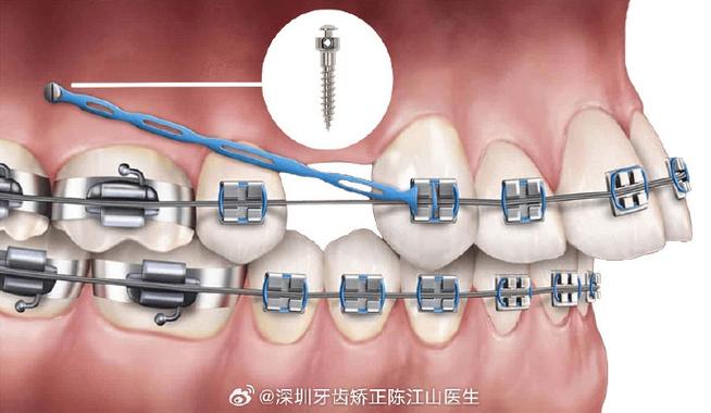 韩式外科牙齿矫正手术与传统矫正有何区别?-图3 韩式外科牙齿矫正手术与传统矫正有何区别?-图3