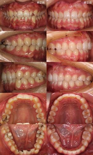 韩式外科牙齿矫正手术与传统矫正有何区别?-图2 韩式外科牙齿矫正手术与传统矫正有何区别?-图2