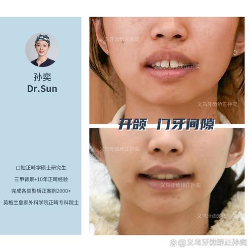 下牙齿缝隙大如何矫正?有哪些有效矫正方法?-图3 下牙齿缝隙大如何矫正?有哪些有效矫正方法?-图3