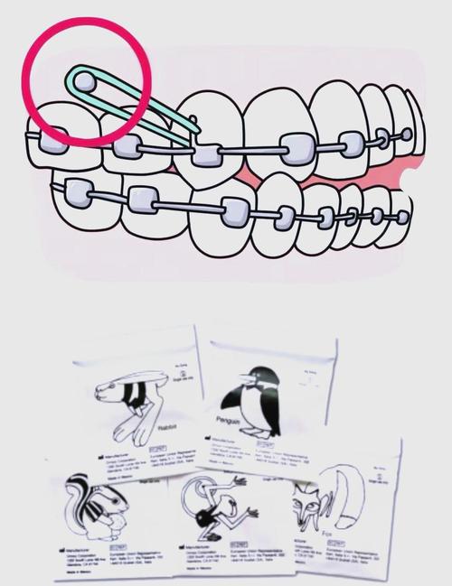 牙齿矫正橡皮筋怎么挂？挂法技巧详解！-图2