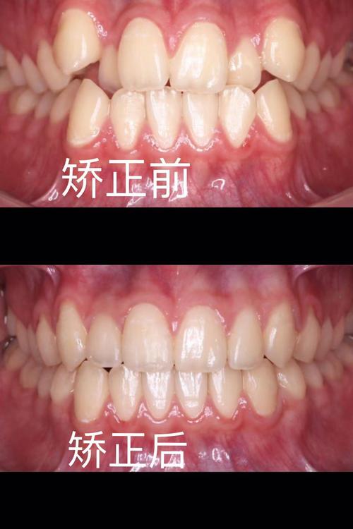 牙齿往内凹矫正前后对比图效果差异有多大?-图1 牙齿往内凹矫正前后对比图效果差异有多大?-图1