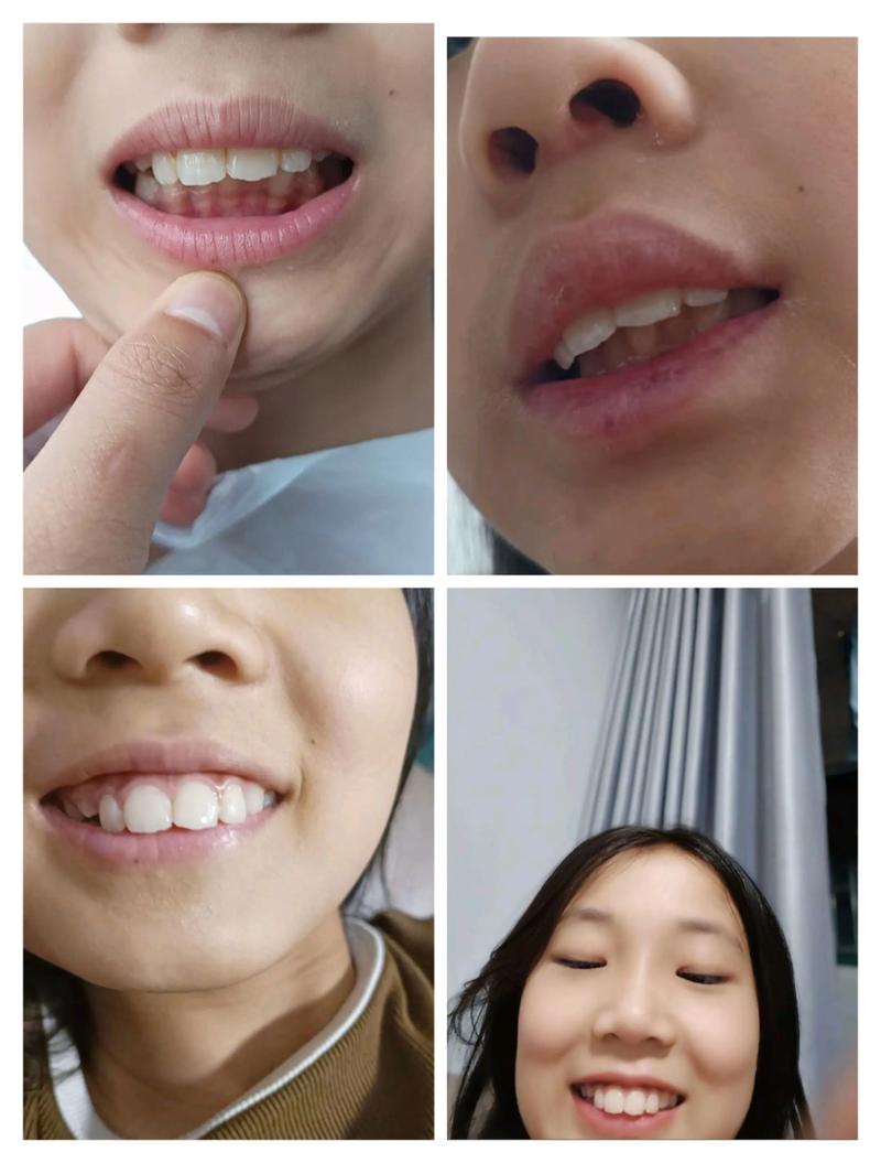牙齿往内凹矫正前后对比图效果差异有多大?-图3 牙齿往内凹矫正前后对比图效果差异有多大?-图3