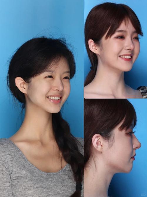 矫正牙齿后侧脸变好看？这背后有什么原因？-图2