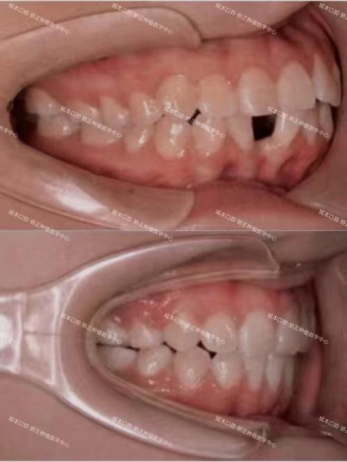 牙齿矫正能改善嘴突吗？-图3