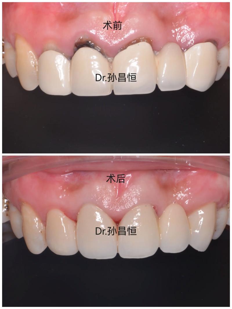 矫正牙齿后大牙烂了两颗该怎么办？-图3