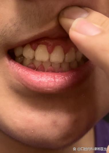 牙齿矫正期间牙龈增生-图1