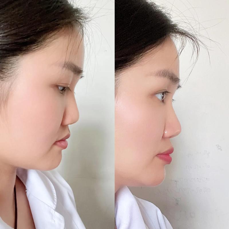 牙齿矫正会改变侧脸吗？-图1