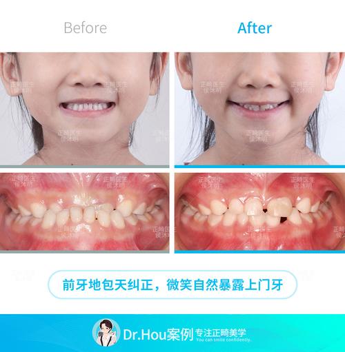 地包天牙齿矫正该怎么做？-图3