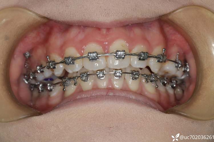 长沙湘雅附二牙齿矫正效果如何？价格贵不贵？-图2