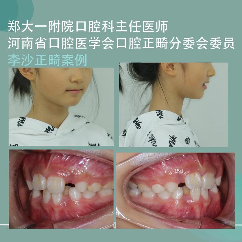 下排牙齿不齐能矫正吗?效果能维持多久?-图2 下排牙齿不齐能矫正吗?效果能维持多久?-图2