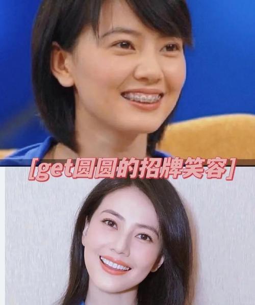 明星牙齿矫正前后图片，变化为何这么大？-图1